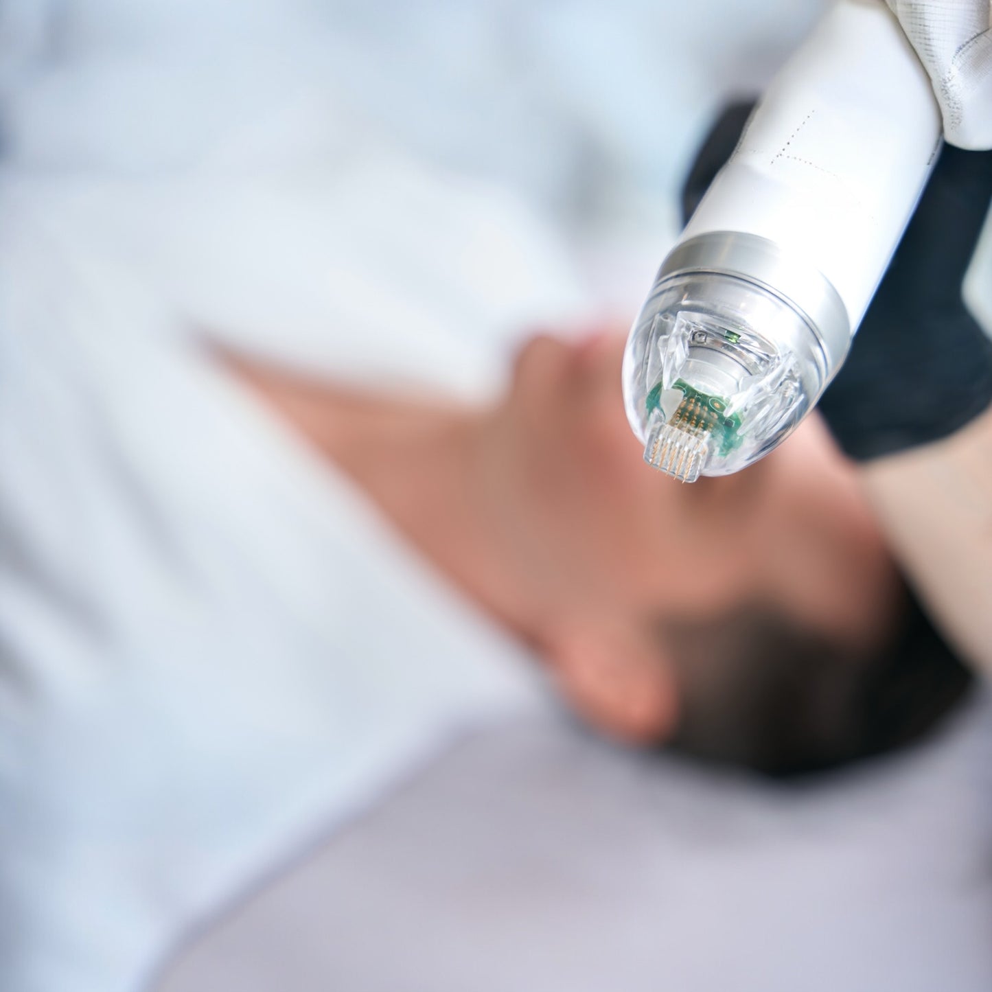 Micro Needling® By VANDA Skin Emporium Advanced Skin Renewal